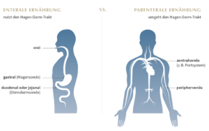 enterale oder parenterale Ernährung - ein Überblick